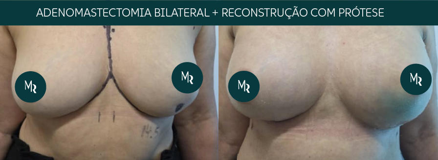 Adenomastectomia bilateral e reconstrução com prótese