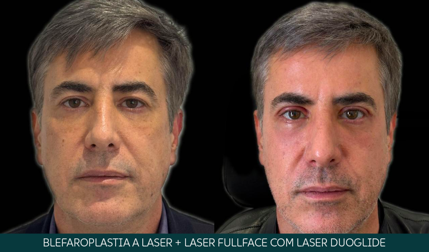 Blefaroplastia a laser e laser fullface com Laser DuoGlide