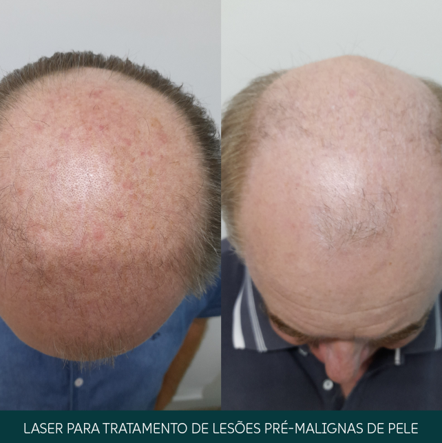 Laser para tratamento de lesões pré-malignas de pele