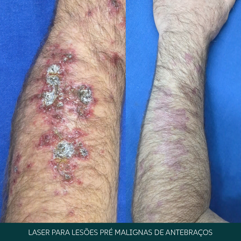 Laser para lesões pré-malignas de antebraços